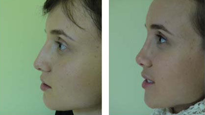 operatie estetica la nas